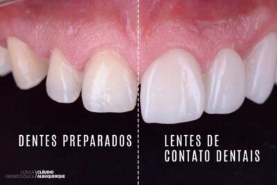 Lentes De Contato Dentais Desgastam Os Dentes