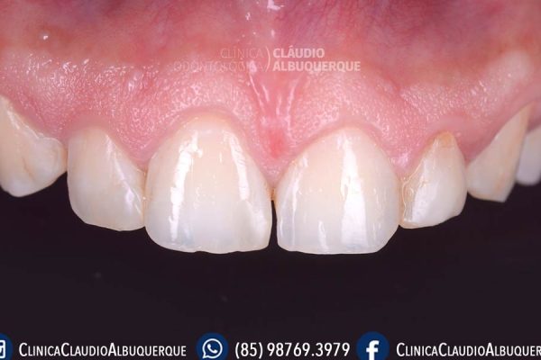 00-DENTES-PEQUENOS-AUMENTO-DE-DENTES-lente-de-contato-dentais-em-fortaleza- 00-DENTES-PEQUENOS-AUMENTO-DE-DENTES-lente-de-contato-dentais-em-fortaleza-