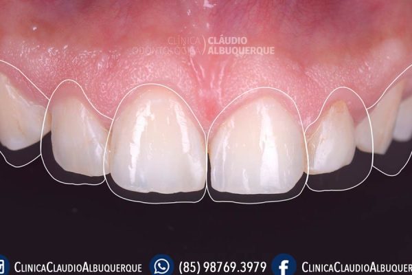 01-DENTES-PEQUENOS-AUMENTO-DE-DENTES-lente-de-contato-dentais-em-fortaleza- 01-DENTES-PEQUENOS-AUMENTO-DE-DENTES-lente-de-contato-dentais-em-fortaleza-