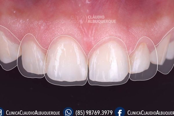 02-DENTES-PEQUENOS-AUMENTO-DE-DENTES-lente-de-contato-dentais-em-fortaleza- 02-DENTES-PEQUENOS-AUMENTO-DE-DENTES-lente-de-contato-dentais-em-fortaleza-