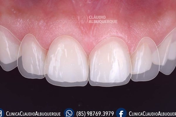 03-DENTES-PEQUENOS-AUMENTO-DE-DENTES-lente-de-contato-dentais-em-fortaleza- 03-DENTES-PEQUENOS-AUMENTO-DE-DENTES-lente-de-contato-dentais-em-fortaleza-