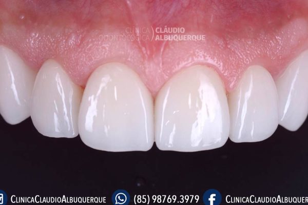 04-DENTES-PEQUENOS-AUMENTO-DE-DENTES-lente-de-contato-dentais-em-fortaleza- 04-DENTES-PEQUENOS-AUMENTO-DE-DENTES-lente-de-contato-dentais-em-fortaleza-