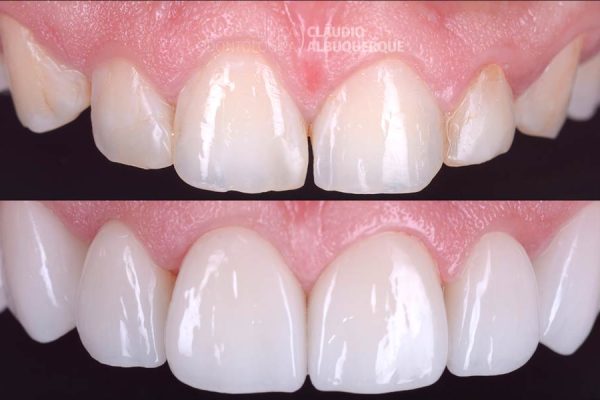 05-DENTES-PEQUENOS-AUMENTO-DE-DENTES-lente-de-contato-dentais-em-fortaleza- 05-DENTES-PEQUENOS-AUMENTO-DE-DENTES-lente-de-contato-dentais-em-fortaleza-