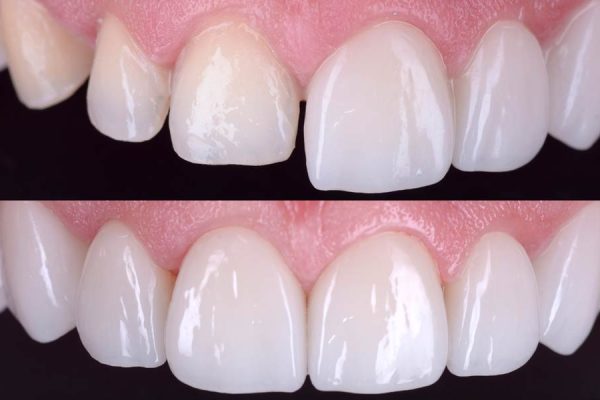 06-DENTES-PEQUENOS-AUMENTO-DE-DENTES-lente-de-contato-dentais-em-fortaleza- 06-DENTES-PEQUENOS-AUMENTO-DE-DENTES-lente-de-contato-dentais-em-fortaleza-