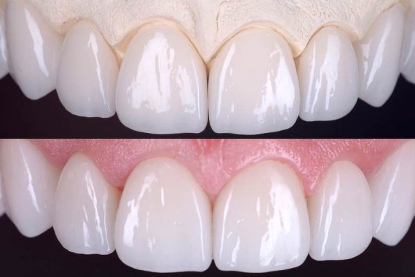 07-DENTES-PEQUENOS-AUMENTO-DE-DENTES-lente-de-contato-dentais-em-fortaleza- 07-DENTES-PEQUENOS-AUMENTO-DE-DENTES-lente-de-contato-dentais-em-fortaleza-