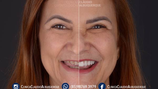 01-lentes-de-contato-dentais-para-dentes-separados-ou-afastados 01-lentes-de-contato-dentais-para-dentes-separados-ou-afastados