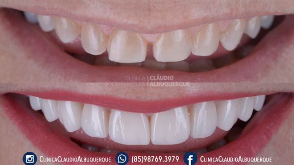 02-lentes-de-contato-dentais-para-dentes-separados-ou-afastados 02-lentes-de-contato-dentais-para-dentes-separados-ou-afastados