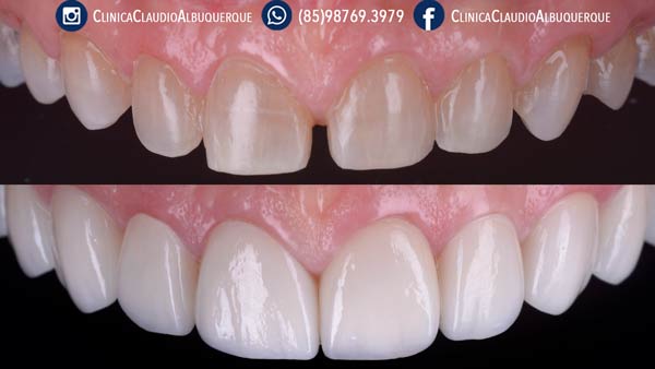 03-lentes-de-contato-dentais-para-dentes-separados-ou-afastados 03-lentes-de-contato-dentais-para-dentes-separados-ou-afastados