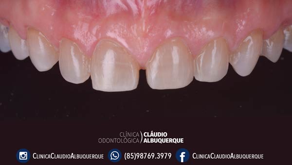 04-lentes-de-contato-dentais-para-dentes-separados-ou-afastados 04-lentes-de-contato-dentais-para-dentes-separados-ou-afastados