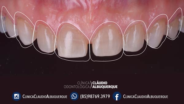 05-lentes-de-contato-dentais-para-dentes-separados-ou-afastados 05-lentes-de-contato-dentais-para-dentes-separados-ou-afastados