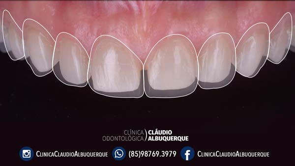 06-lentes-de-contato-dentais-para-dentes-separados-ou-afastados 06-lentes-de-contato-dentais-para-dentes-separados-ou-afastados