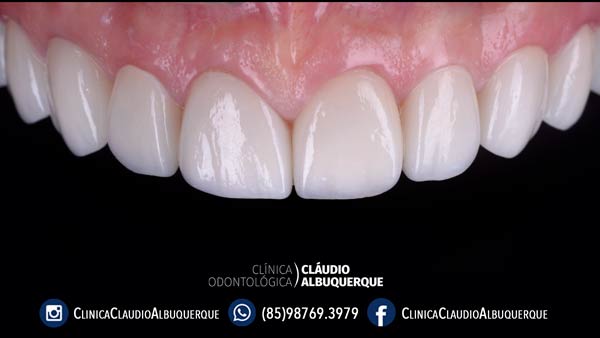 07-lentes-de-contato-dentais-para-dentes-separados-ou-afastados 07-lentes-de-contato-dentais-para-dentes-separados-ou-afastados