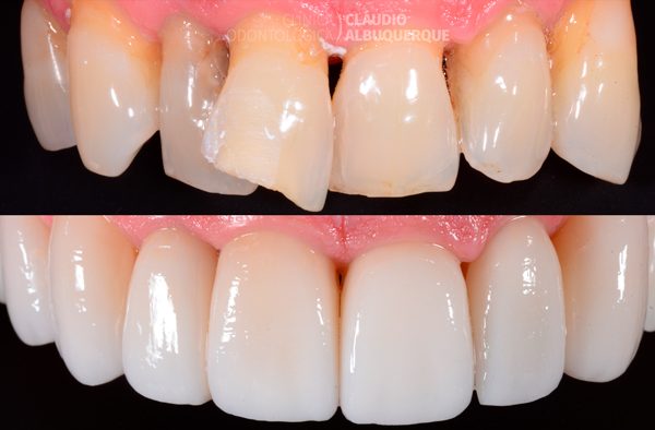 LENTES-DE-CONTATO-DENTAIS-EM-FORTALEZA-PARA-DENTES-TORTOS-GIRADOS-OU-ENTARAMELADOS-1 LENTES-DE-CONTATO-DENTAIS-EM-FORTALEZA-PARA-DENTES-TORTOS-GIRADOS-OU-ENTARAMELADOS-1