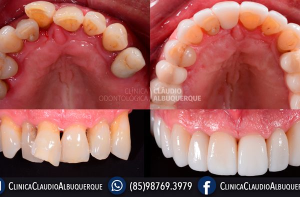 LENTES-DE-CONTATO-DENTAIS-EM-FORTALEZA-PARA-DENTES-TORTOS-GIRADOS-OU-ENTARAMELADOS-2 LENTES-DE-CONTATO-DENTAIS-EM-FORTALEZA-PARA-DENTES-TORTOS-GIRADOS-OU-ENTARAMELADOS-2