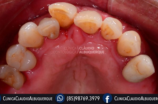 LENTES-DE-CONTATO-DENTAIS-EM-FORTALEZA-PARA-DENTES-TORTOS-GIRADOS-OU-ENTARAMELADOS-3 LENTES-DE-CONTATO-DENTAIS-EM-FORTALEZA-PARA-DENTES-TORTOS-GIRADOS-OU-ENTARAMELADOS-3