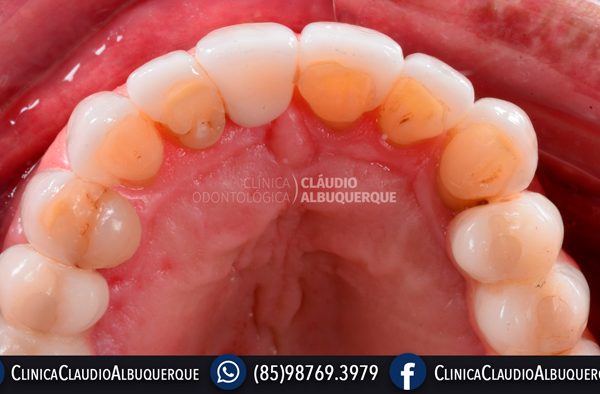 LENTES-DE-CONTATO-DENTAIS-EM-FORTALEZA-PARA-DENTES-TORTOS-GIRADOS-OU-ENTARAMELADOS-4 LENTES-DE-CONTATO-DENTAIS-EM-FORTALEZA-PARA-DENTES-TORTOS-GIRADOS-OU-ENTARAMELADOS-4
