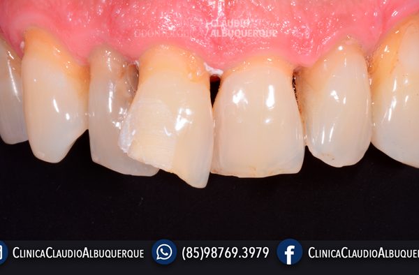LENTES-DE-CONTATO-DENTAIS-EM-FORTALEZA-PARA-DENTES-TORTOS-GIRADOS-OU-ENTARAMELADOS-5 LENTES-DE-CONTATO-DENTAIS-EM-FORTALEZA-PARA-DENTES-TORTOS-GIRADOS-OU-ENTARAMELADOS-5