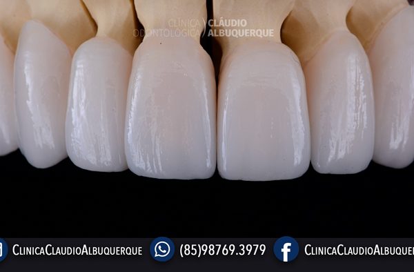 LENTES-DE-CONTATO-DENTAIS-EM-FORTALEZA-PARA-DENTES-TORTOS-GIRADOS-OU-ENTARAMELADOS-6 LENTES-DE-CONTATO-DENTAIS-EM-FORTALEZA-PARA-DENTES-TORTOS-GIRADOS-OU-ENTARAMELADOS-6