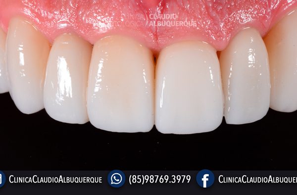 LENTES-DE-CONTATO-DENTAIS-EM-FORTALEZA-PARA-DENTES-TORTOS-GIRADOS-OU-ENTARAMELADOS-7 LENTES-DE-CONTATO-DENTAIS-EM-FORTALEZA-PARA-DENTES-TORTOS-GIRADOS-OU-ENTARAMELADOS-7