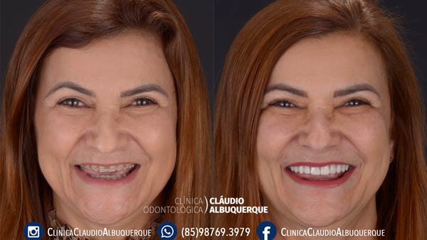 lentes-de-contato-dentais-para-dentes-separados-ou-afastados