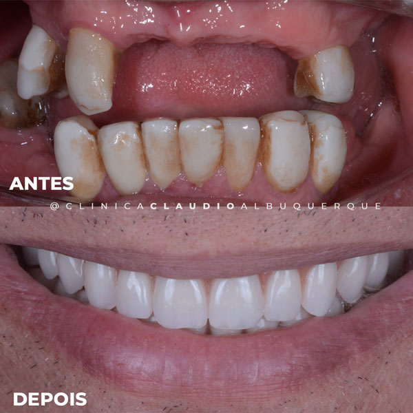 clinica-implantes-dentarios-fortaleza clinica-implantes-dentarios-fortaleza