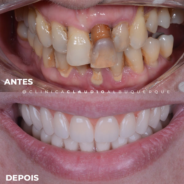 dentista-especialista-em-implante-fortaleza dentista-especialista-em-implante-fortaleza