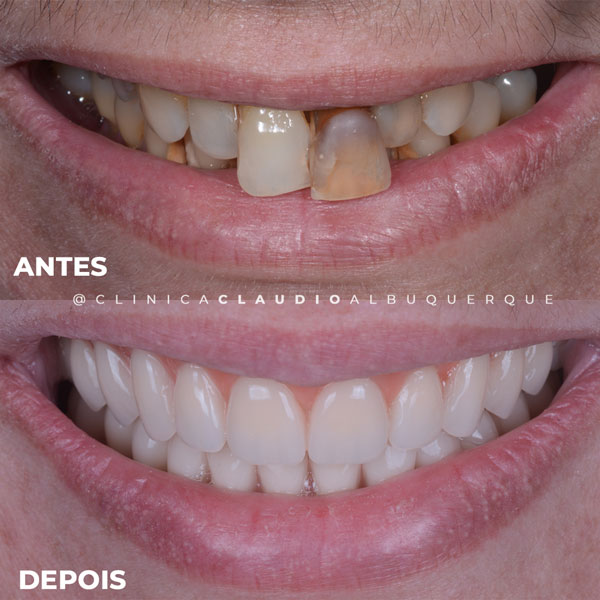 dentista-implante-fortaleza dentista-implante-fortaleza