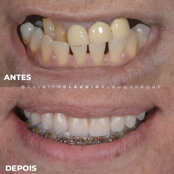implante-de-dente-em-fortaleza implante-de-dente-em-fortaleza