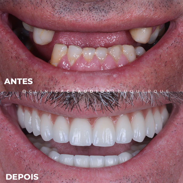 implantes-de-dente-em-fortaleza implantes-de-dente-em-fortaleza