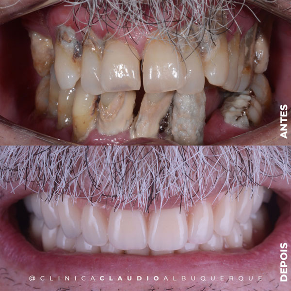 implantes-dentais-fortaleza implantes-dentais-fortaleza