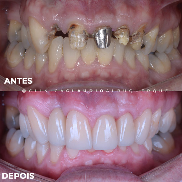 implantes-dentarios-fortaleza-dentes-totais implantes-dentarios-fortaleza-dentes-totais