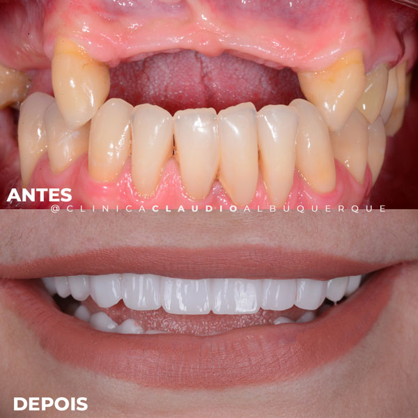 melhor-dentista-especialista-em-implante-fortaleza melhor-dentista-especialista-em-implante-fortaleza